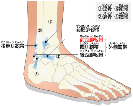 sprain_of_ankle_html.gif